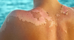 oparzenie słoneczne